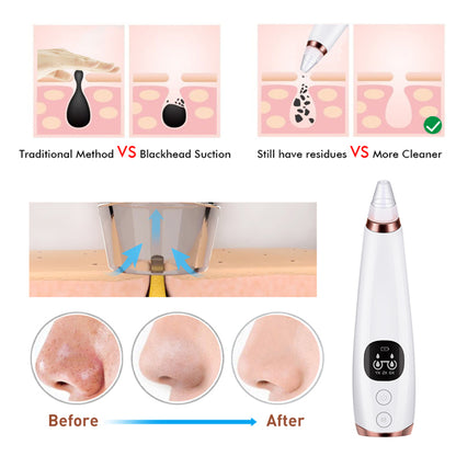 Blackhead Vacuum Pore Cleanser | 5-Head Microdermabrasion Device